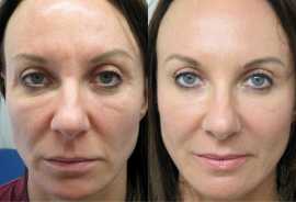 Vampire Facelift Treatment in Warrenton, Warrenton