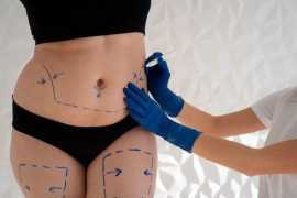 Coolsculpting in Dubai, Dubai
