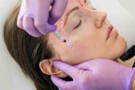 Achieve a Youthful Look with Dermal Filler , Warrenton