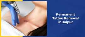 Safe and Effective Permanent Tattoo Removal in Raj, Jaipur