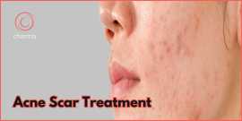 Acne Scar Treatment in Bangalore, Bengaluru