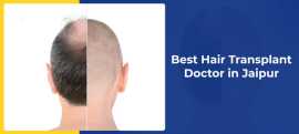 What Makes the Best Hair Transplant Doctor in Jaip, Jaipur