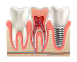 Get Your Confidence Back with Top-Quality Dental I, Warriewood