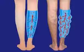 Best Doctor for Varicose Veins: Your Path to Safe , Chandigarh