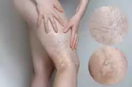 Top Vein Specialist Doctor for Advanced Vein Care , Mohali