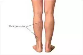 Best Hospital for Varicose Vein Treatment in India, Chandigarh