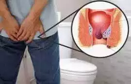 Book the Best Hospital for Piles Surgery Treatment, Noida