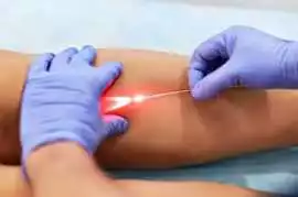 Find the Best Doctor for Varicose Veins, Chandigarh