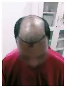 Effective Hair Fall Treatment in Coimbatore at Der, Coimbatore