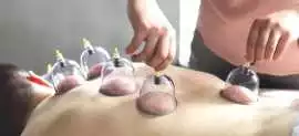 Dry Cupping Therapy in Dubai – Natural Healing, Dubai