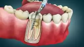 Trusted Root Canal Dental Clinic , Thane