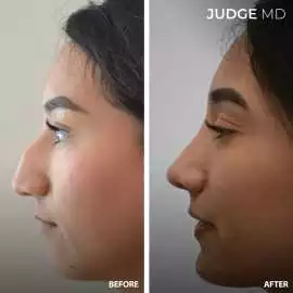 Rhinoplasty San Francisco - JudgeMD, San Francisco
