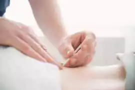Trigger Point Dry Needling Therapy - Grand Madison, New York