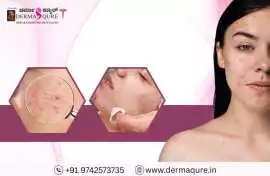 Acne Scar Treatment in Bangalore at Dermaqure, Bengaluru