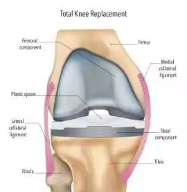 Opt for Reliable Total Knee Joint Replacement, Sandringham