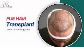 PRP Therapy for Hair Growth | FUE Hair Transplant, Gurgaon