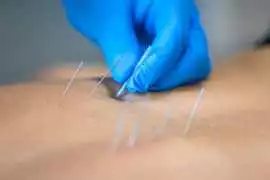 Restore Calm with Acupuncture for Anxiety in NYC, New York