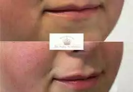 Where Can You Get the Best Botox in Highlands NC? , New York