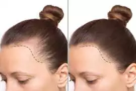 Scalp Micropigmentation Creates Hair-Follicle, Vancouver