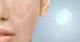 Effective Acne Scar Treatment in Dubai for Smooth,, Dubai