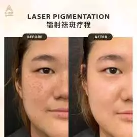Erase Dark Spots Safely with Advanced Laser Treatm, Petaling Jaya