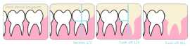 5 Ultimate benefits of composite veneers, Bukit Timah