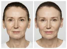 Restylane Treatment in New Jersey, Iselin