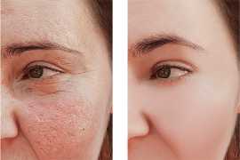 Laser Skin Resurfacing in New Jersey, Iselin