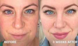 PRP Microneedling Treatment in New Jersey, Iselin