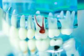 Cost of Root Canal Treatment Pathak Dental Clinic, Pune