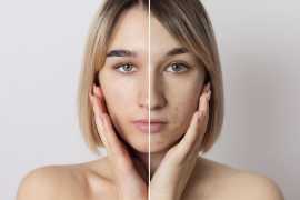Reclaim Your Confidence: Expert Acne Scar Treatmen, Bukit Timah