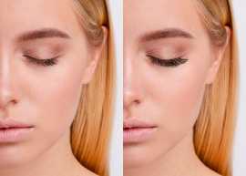 Asian Eyelid Surgery in San Francisco, CA, San Francisco