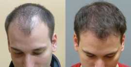 Neograft Hair Transplant in New Jersey, Iselin
