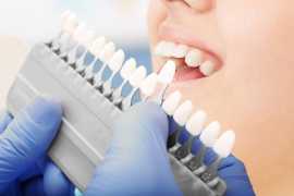 Veneers in Northeast Philadelphia, Philadelphia