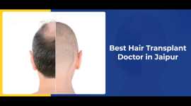 How Modern Techniques Impact Hair Transplantation , Jaipur