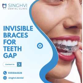 Invisible Braces for Teeth Gap| Singhvi Dental Cli, Jaipur