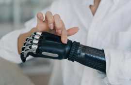 Affordable Prosthetic Arm Solutions, Woodlands New Town