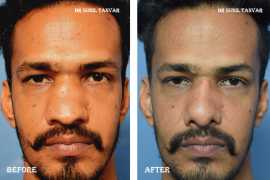 Explore Nose Surgery Benefits, Jaipur