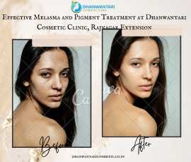 Effective Melasma and Pigment Treatment , Noida