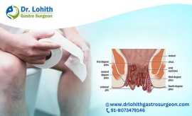 Best Piles Treatment in Bangalore - Dr. Lohith U, Bengaluru