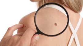 Professional Skin Tag Removal by Dermatologists , London