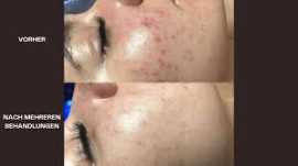 Hydrafacial in Wien – Strahlende Haut im Vienna Ae, Vienna