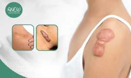 Best Clinic for Keloid Scar Treatment in Bangalore, Bengaluru