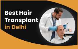 Get Ready For The Best Hair Transplant In Delhi, New Delhi