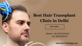 Best Hair Transplant Clinic In Delhi - DMC, New Delhi