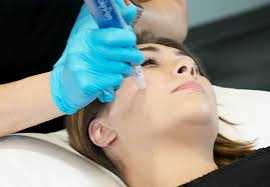 Medizinisches Microneedling mit SkinPen in Wien – , Vienna