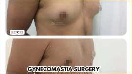 Gynecomastia Surgery In Bangalore, Bengaluru