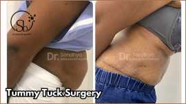 Tummy Tuck Surgery In Bangalore, Bengaluru