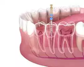 Rotary Endodontic Courses in India., Noida