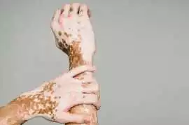 Vitiligo Treatment in Kerala, Tiruvalla